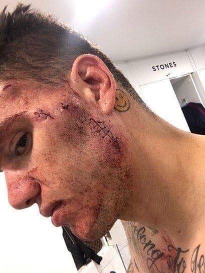 Le visage tuméfié d'Ederson (Man. City) après le choc subi face à S. Mané (Liverpool) ce week-end.